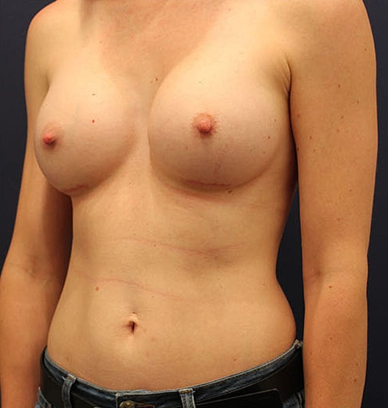 Breast Augmentation Before & After