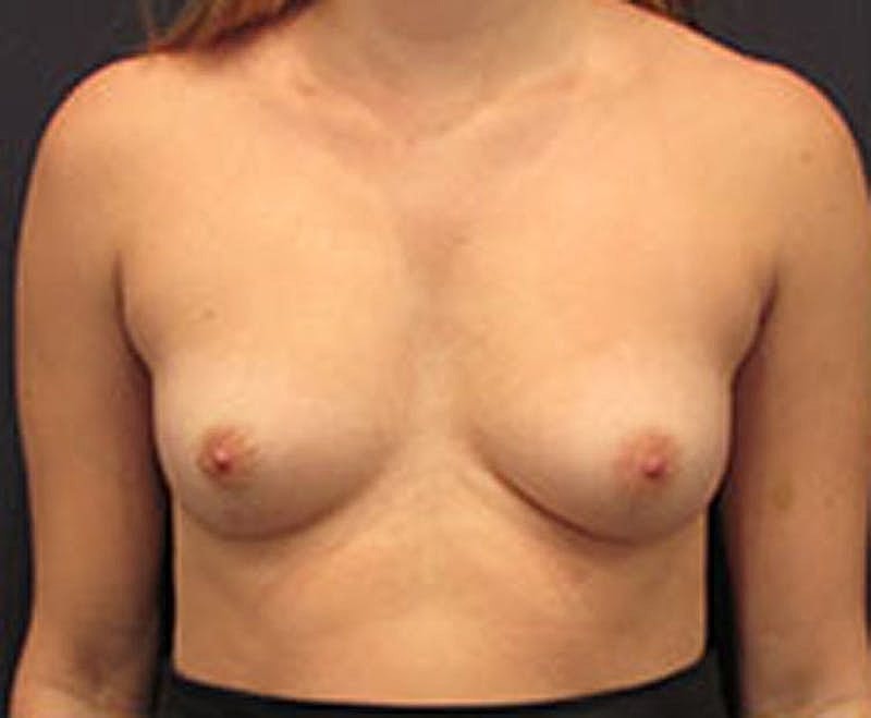 Breast Augmentation Before & After
