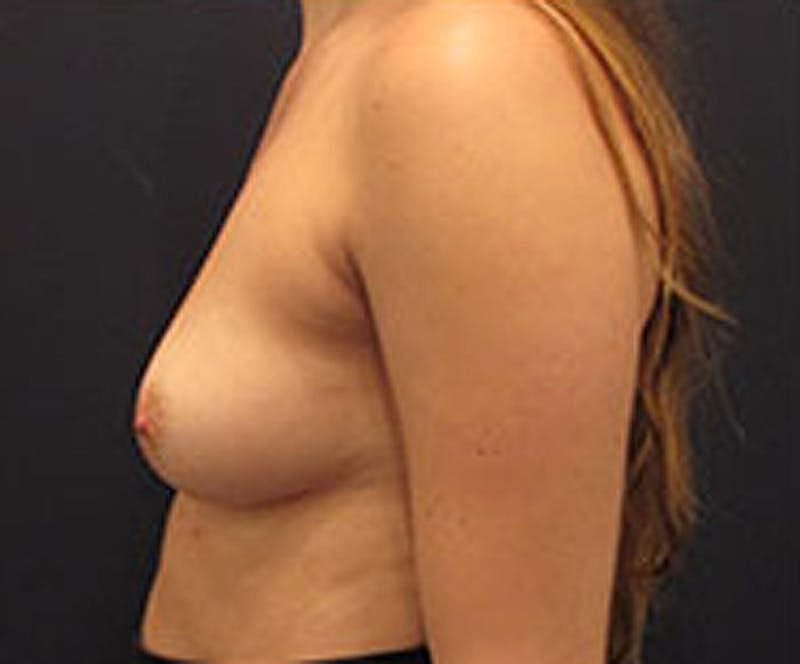 Breast Augmentation Before & After