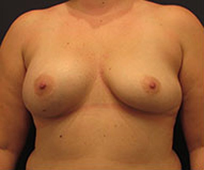 Breast Augmentation Before & After