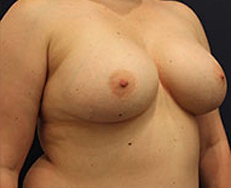 Breast Augmentation Before & After