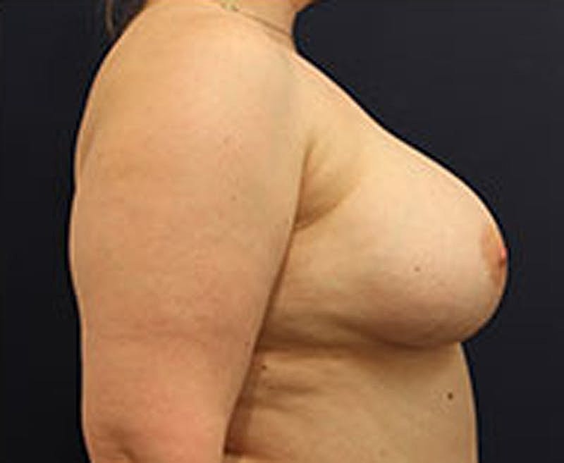 Breast Augmentation Before & After