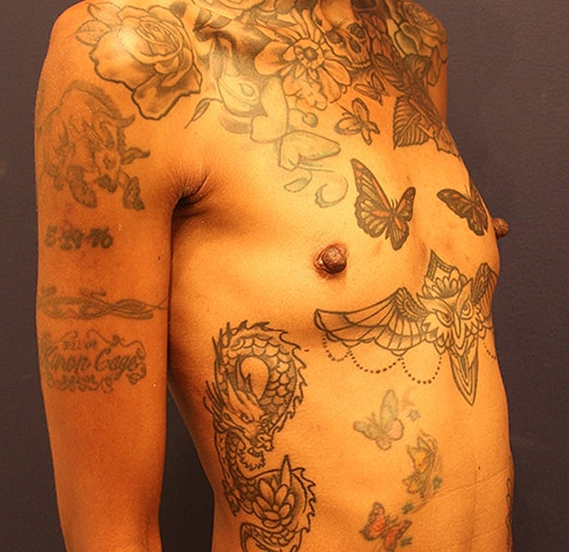 Breast Augmentation Before & After