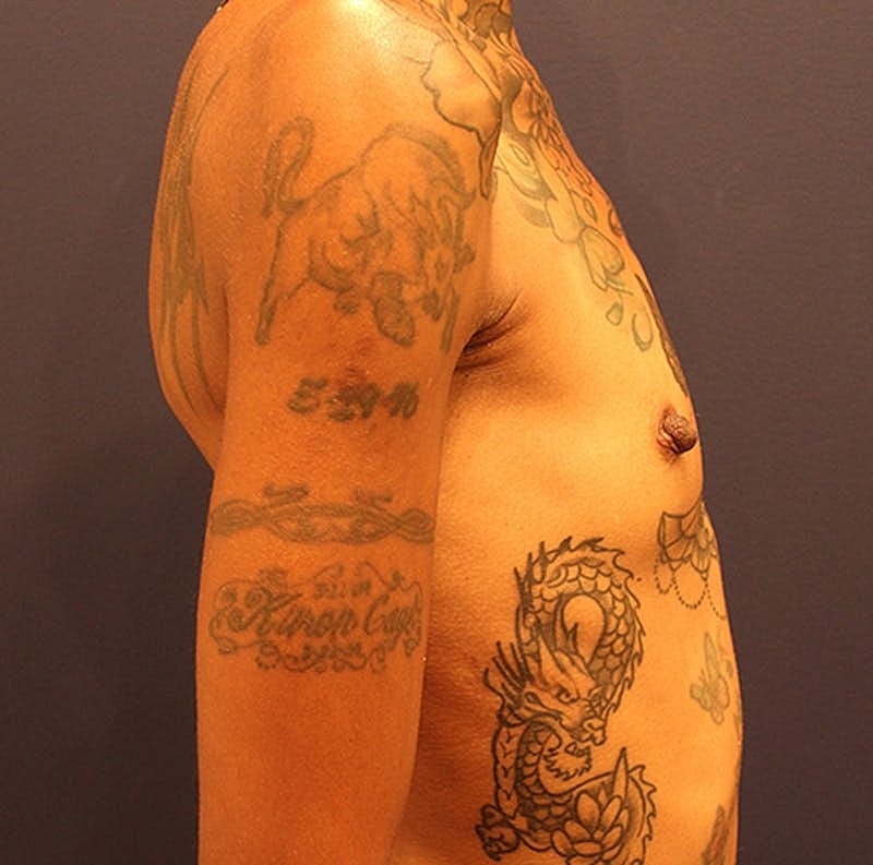 Breast Augmentation Before & After