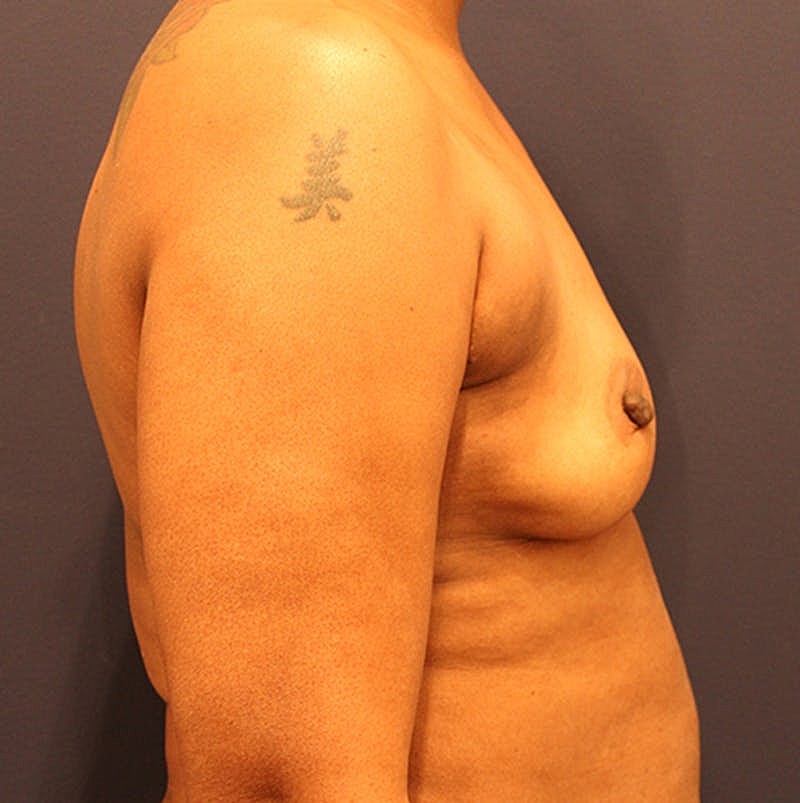 Breast Augmentation Before & After