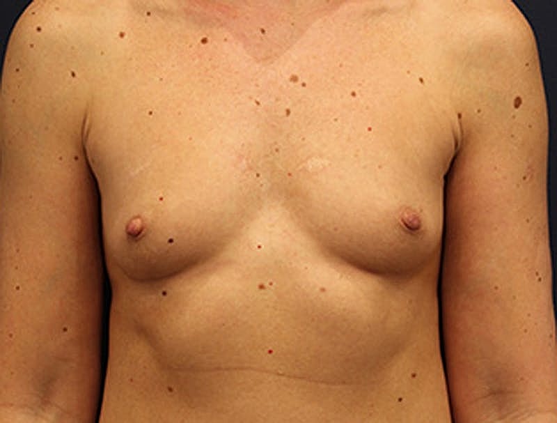Breast Augmentation Before & After