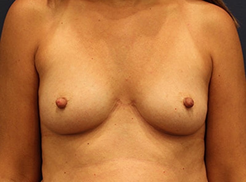 Breast Augmentation Before & After