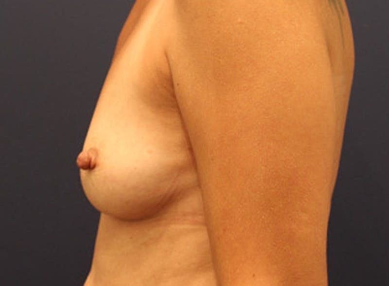 Breast Augmentation Before & After
