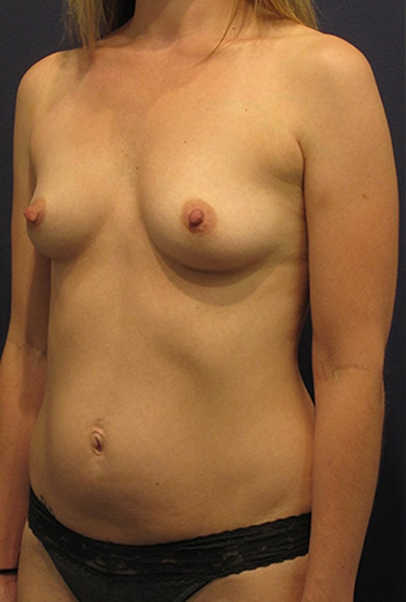 Breast Augmentation Before & After