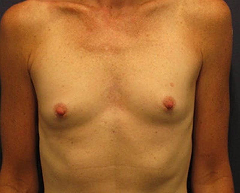 Breast Augmentation Before & After