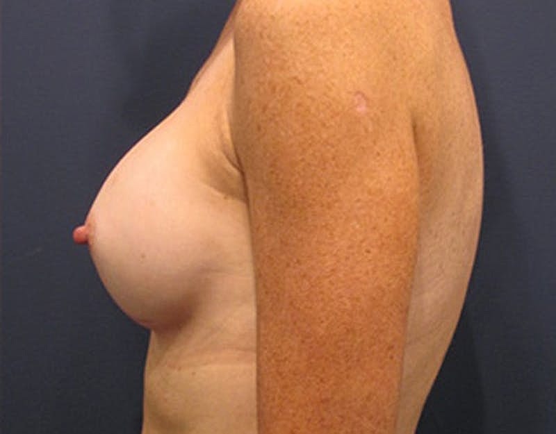 Breast Augmentation Before & After