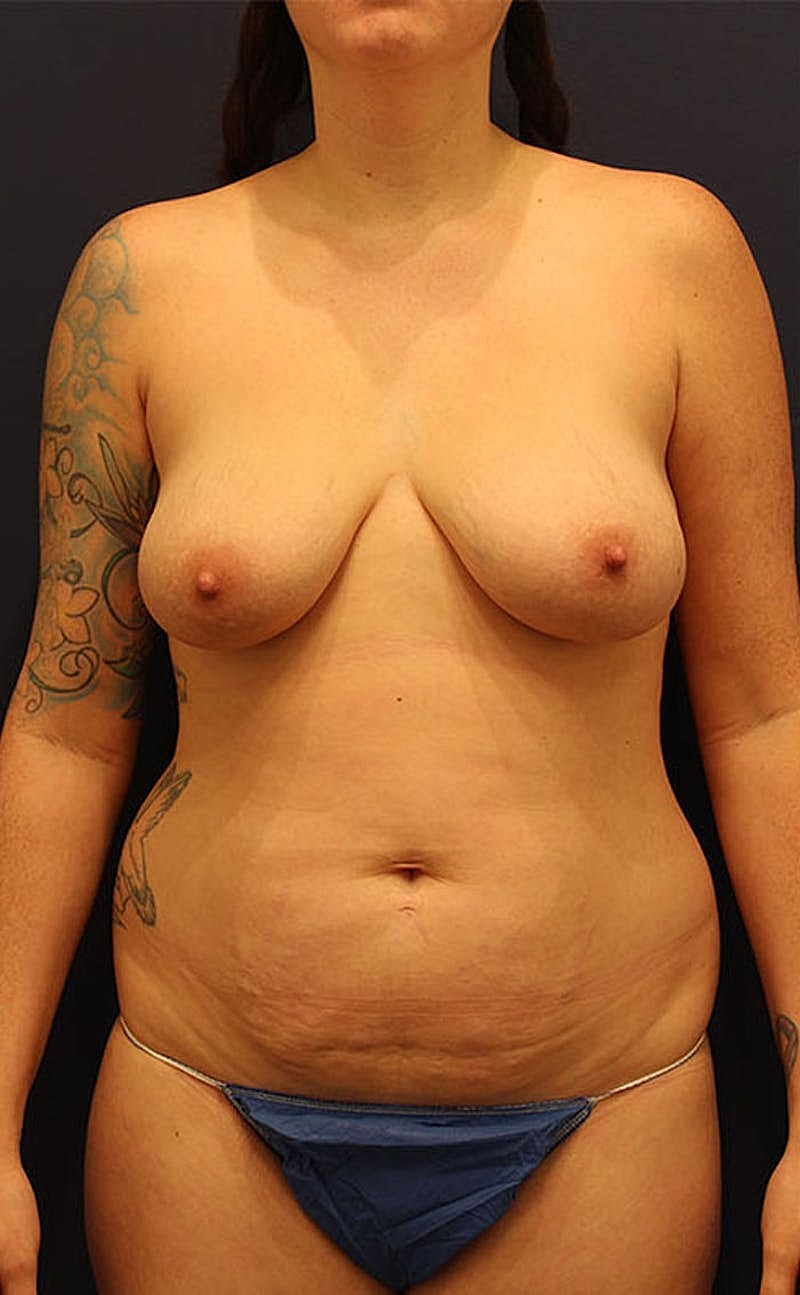 Breast Augmentation Before & After