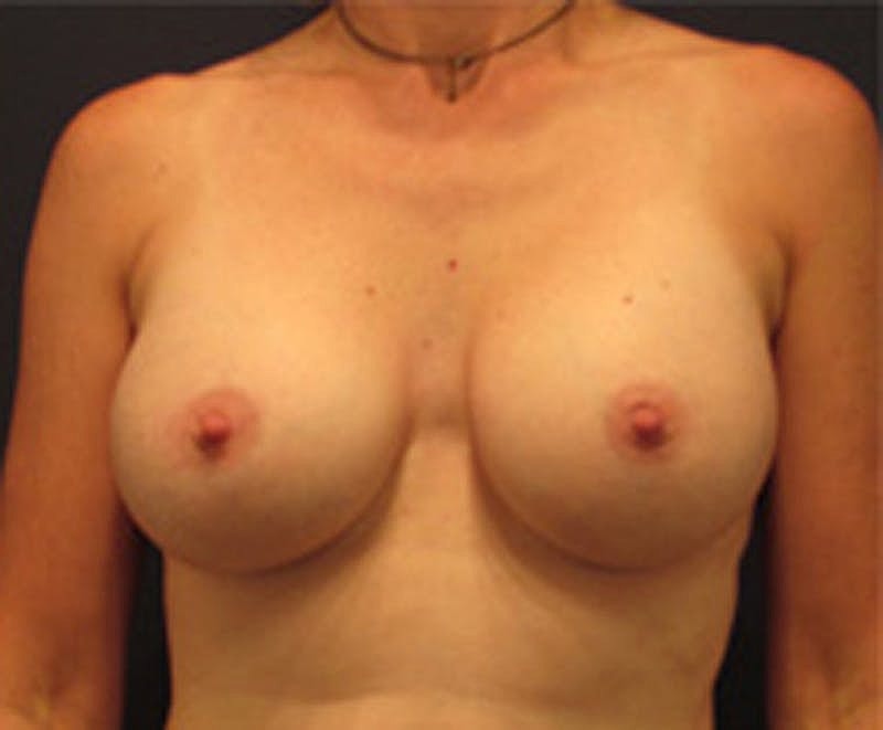 Breast Augmentation Before & After