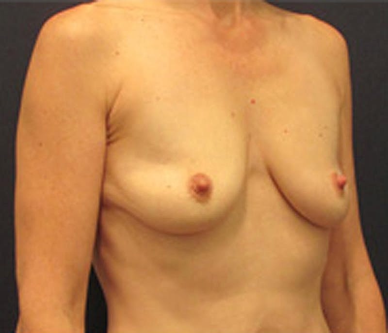 Breast Augmentation Before & After