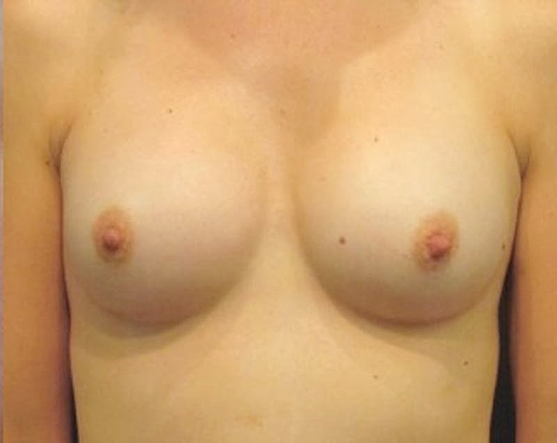 Breast Augmentation Before & After