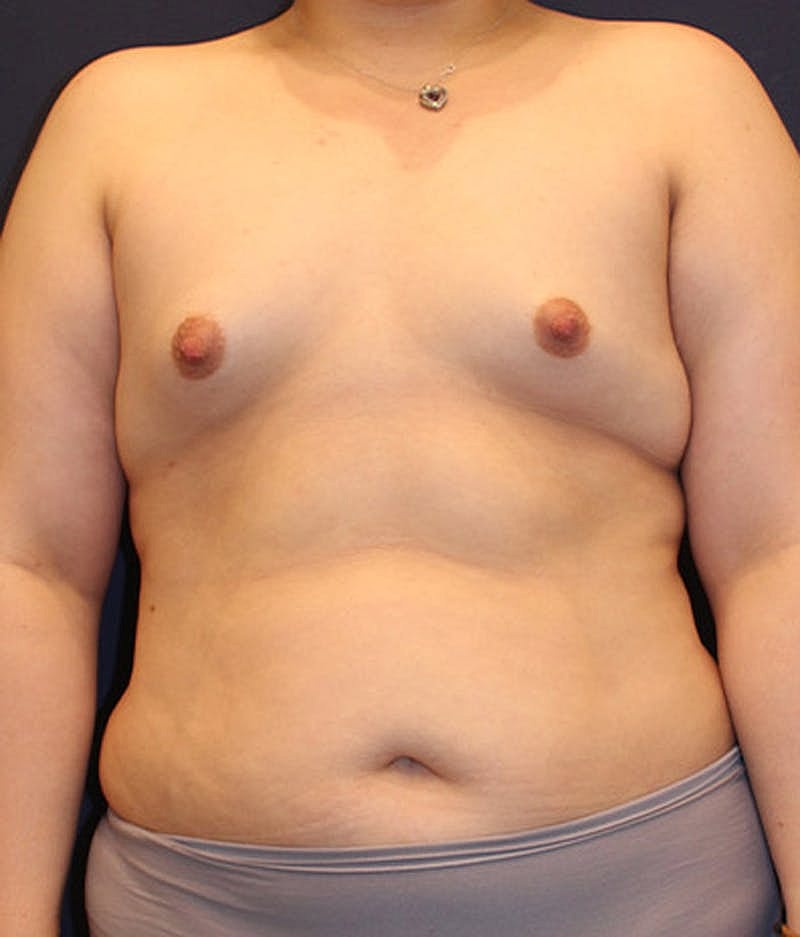 Breast Augmentation Before & After
