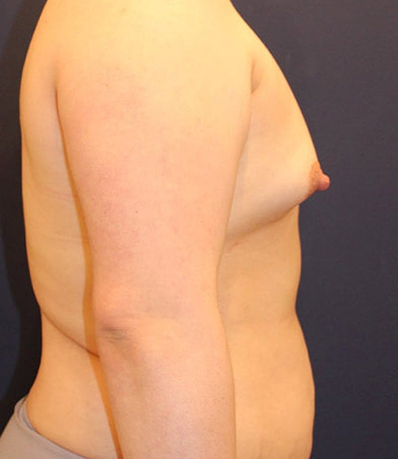 Breast Augmentation Before & After