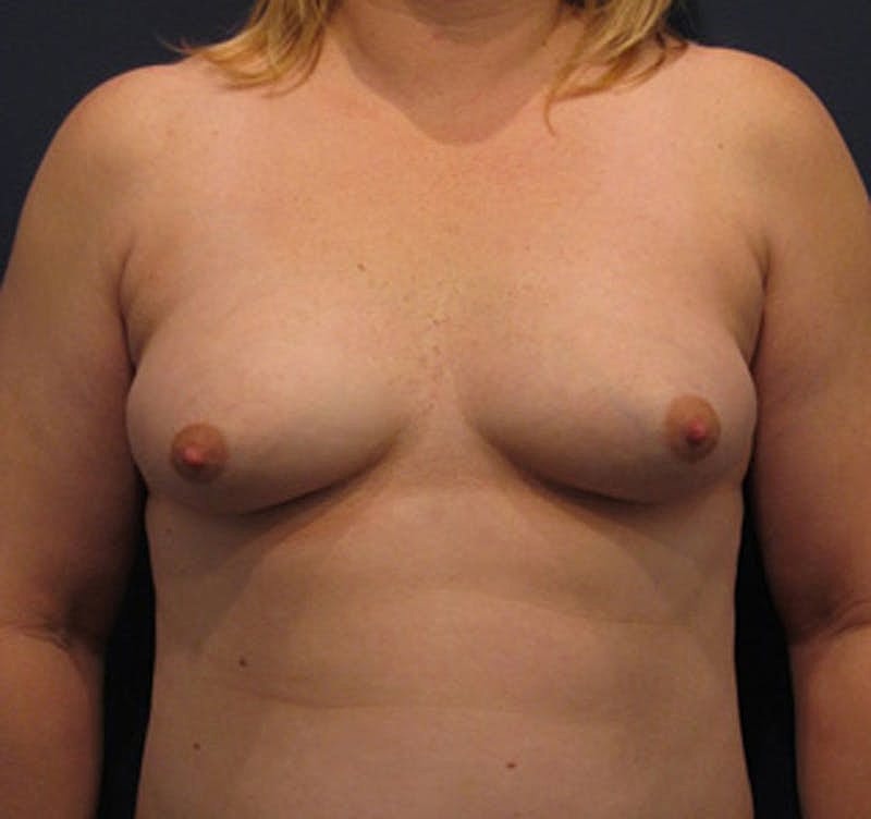 Breast Augmentation Before & After