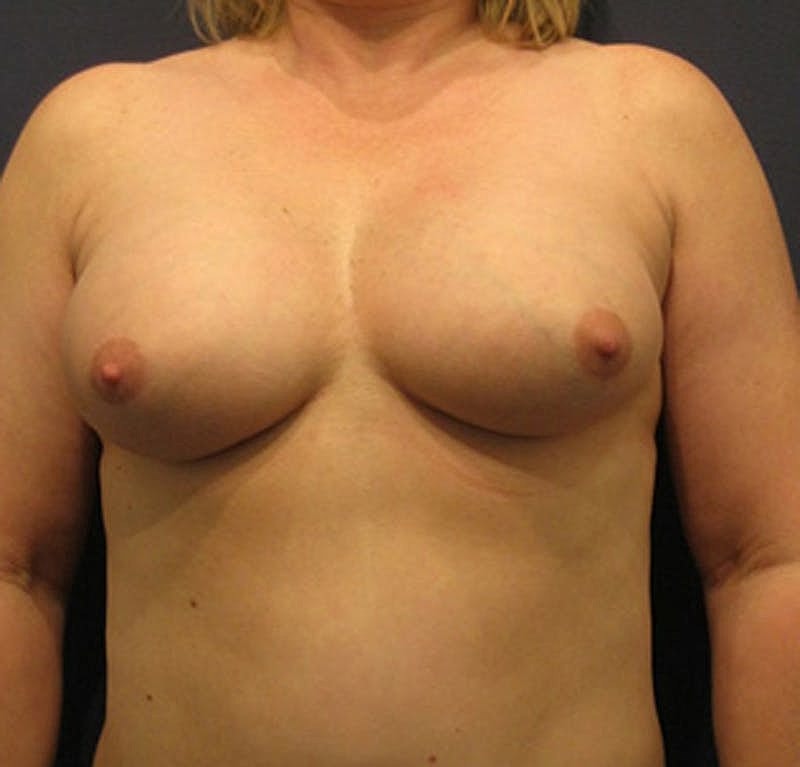 Breast Augmentation Before & After