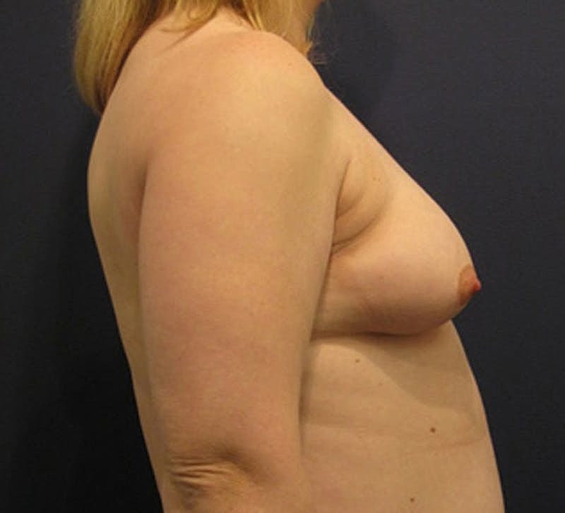 Breast Augmentation Before & After