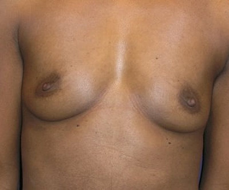 Breast Augmentation Before & After