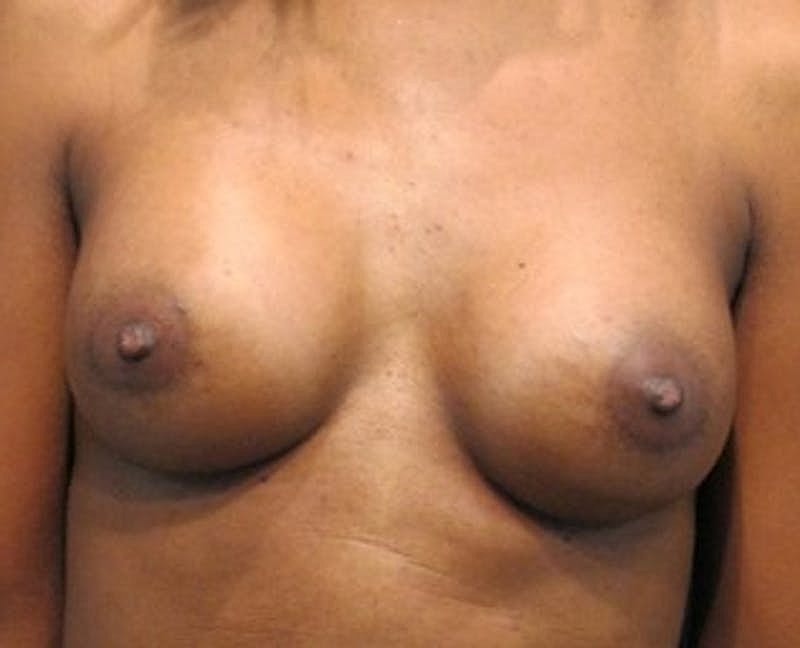 Breast Augmentation Before & After