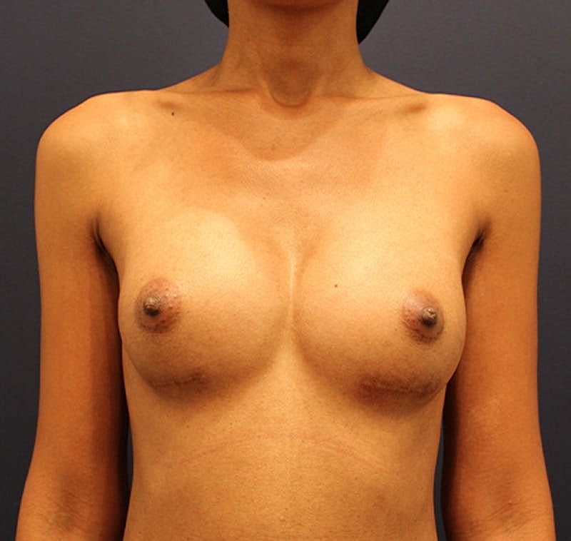 Breast Augmentation Before & After