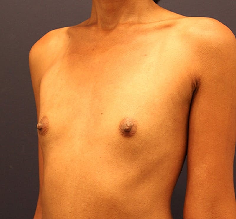 Breast Augmentation Before & After