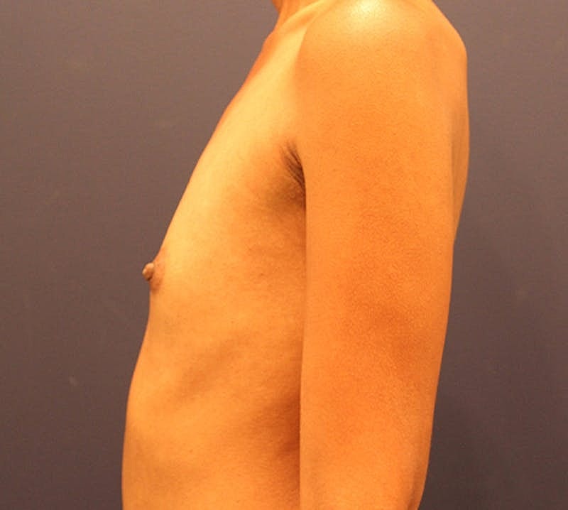 Breast Augmentation Before & After