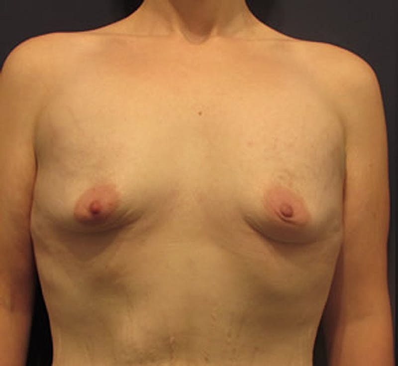 Breast Augmentation Before & After