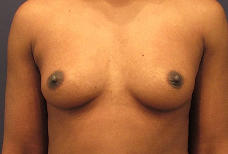 Breast Augmentation Before & After