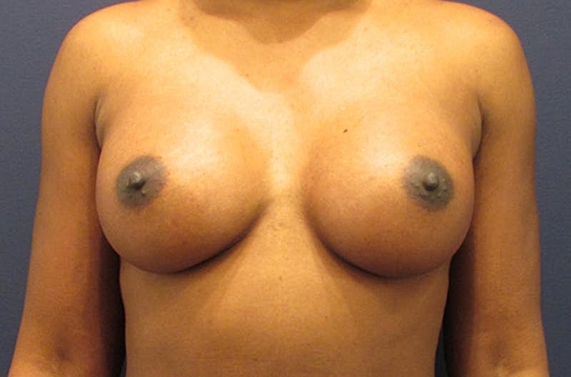 Breast Augmentation Before & After