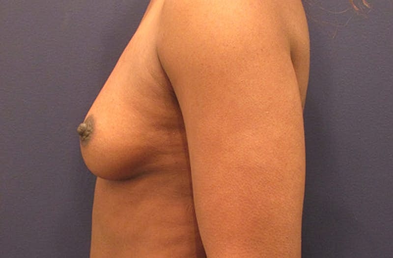 Breast Augmentation Before & After