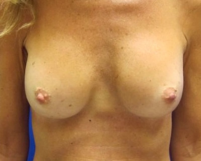 Breast Augmentation Before & After