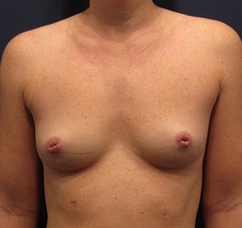 Breast Augmentation Before & After