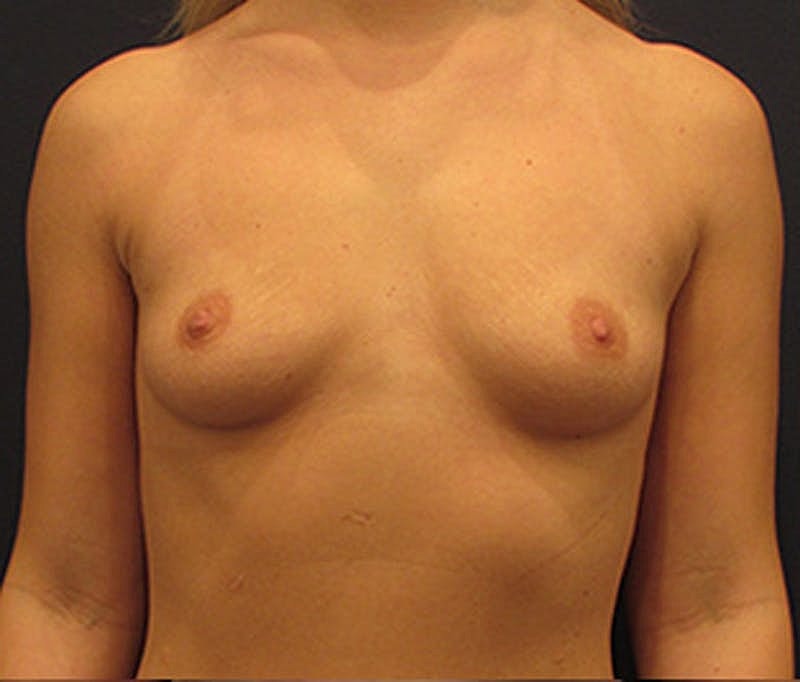 Breast Augmentation Before & After