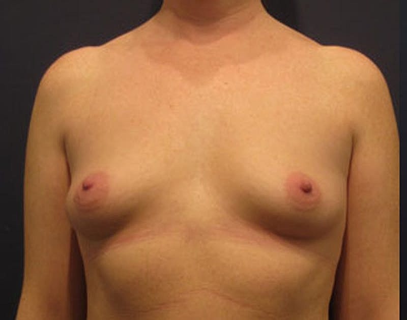 Breast Augmentation Before & After