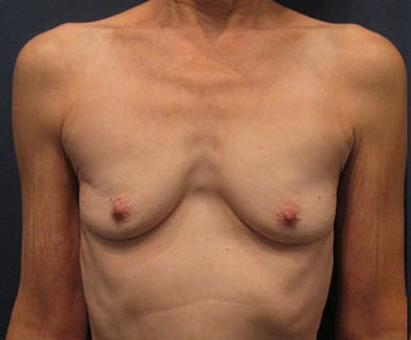 Breast Augmentation Before & After