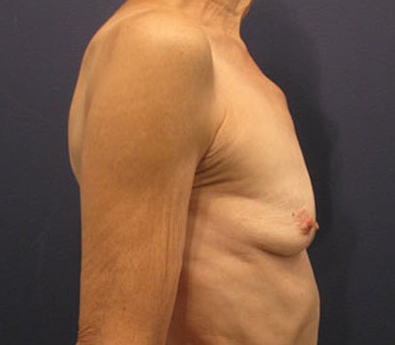 Breast Augmentation Before & After