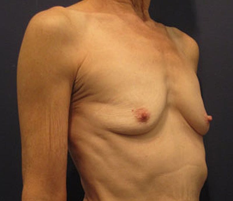 Breast Augmentation Before & After