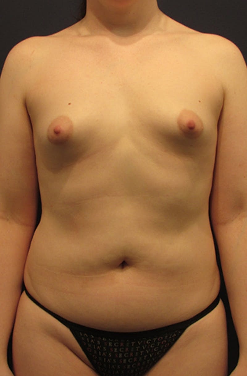 Breast Augmentation Before & After