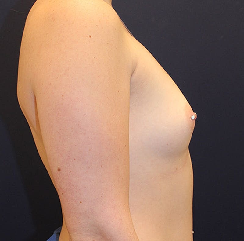 Breast Augmentation Before & After