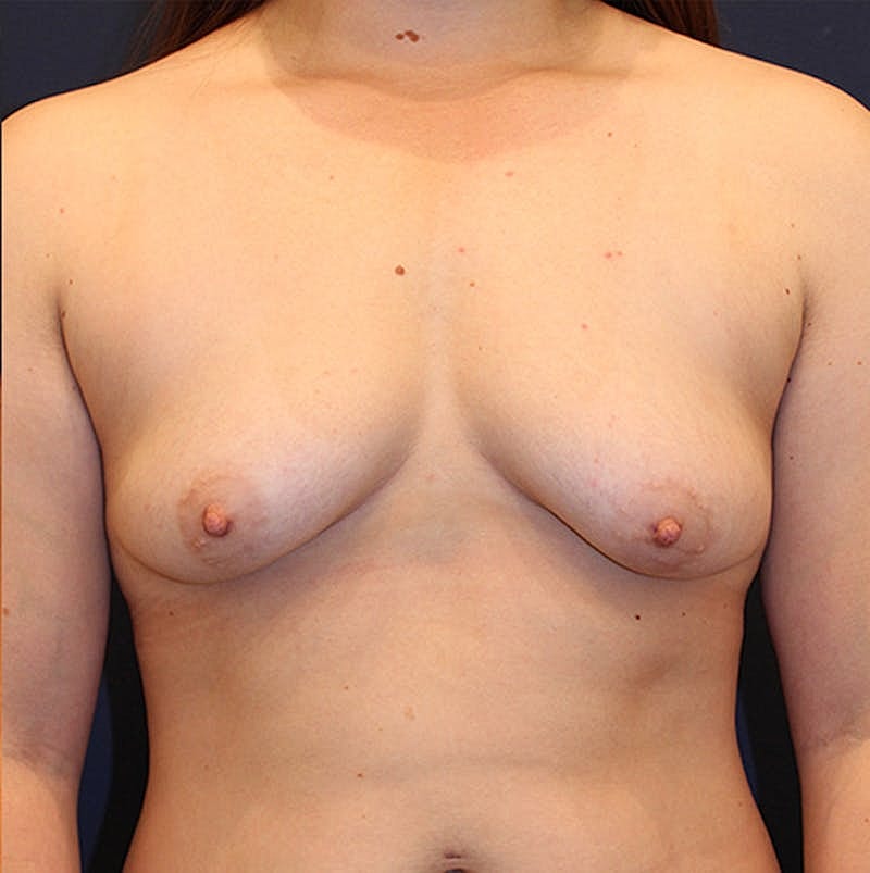 Breast Augmentation Before & After