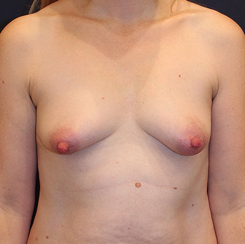 Breast Augmentation Before & After