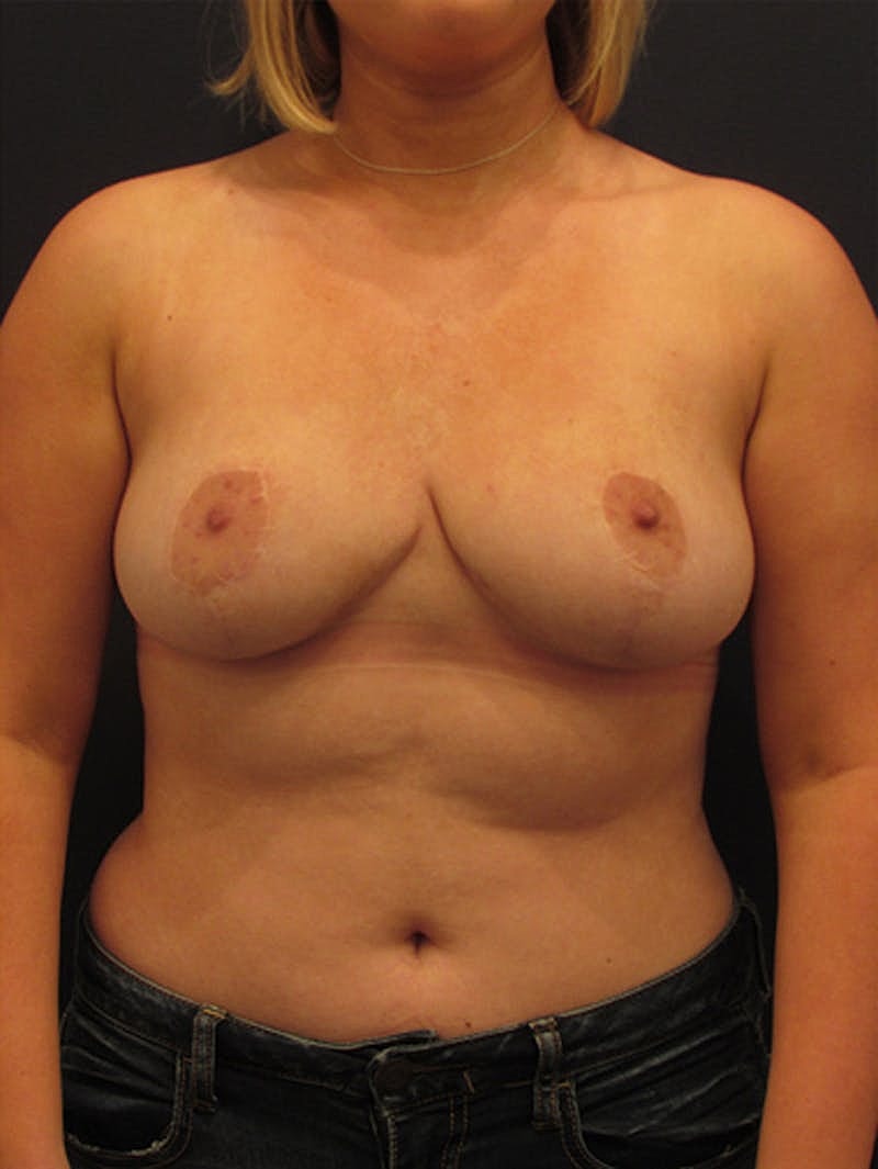 Breast Reduction Before & After