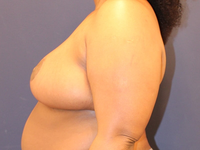Breast Reduction Gallery Before & After