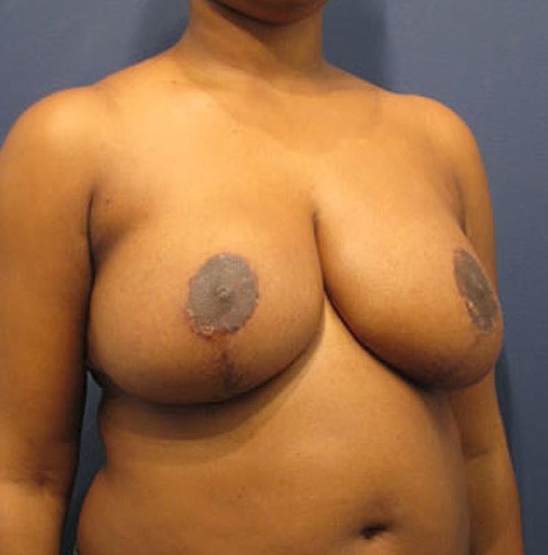 Breast Reduction Before & After
