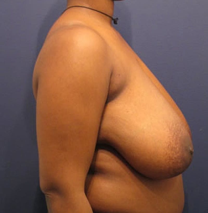 Breast Reduction Before & After