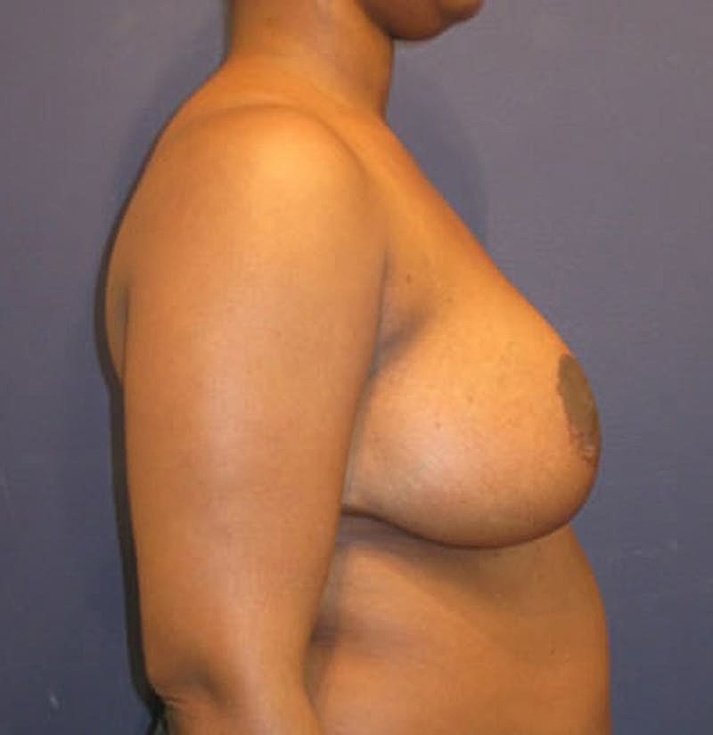 Breast Reduction Before & After