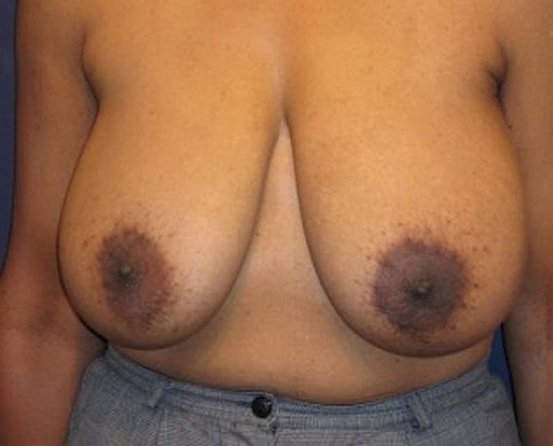 Breast Reduction Before & After